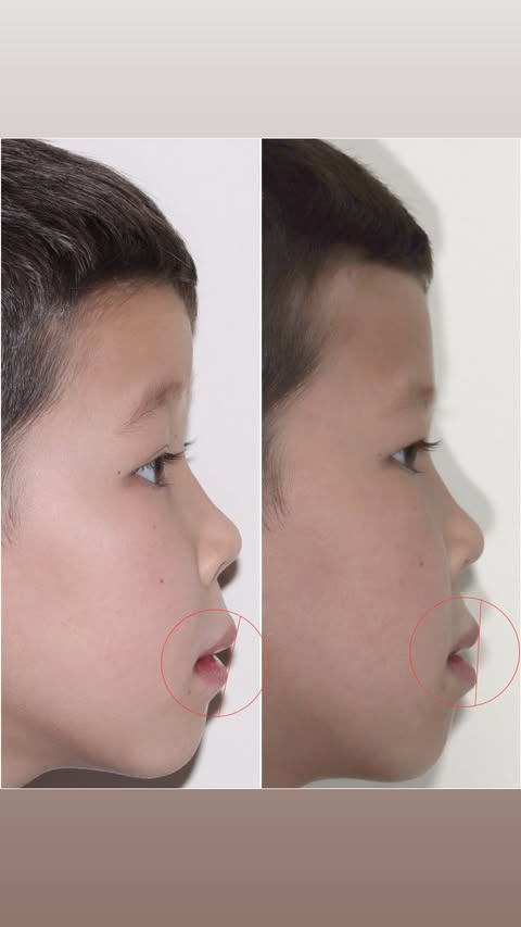 До ортодонтического лечения — профиль лица