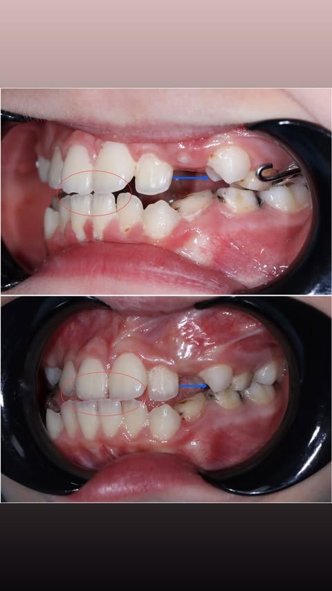 До лечения — фронтальные зубы с нарушением прикуса