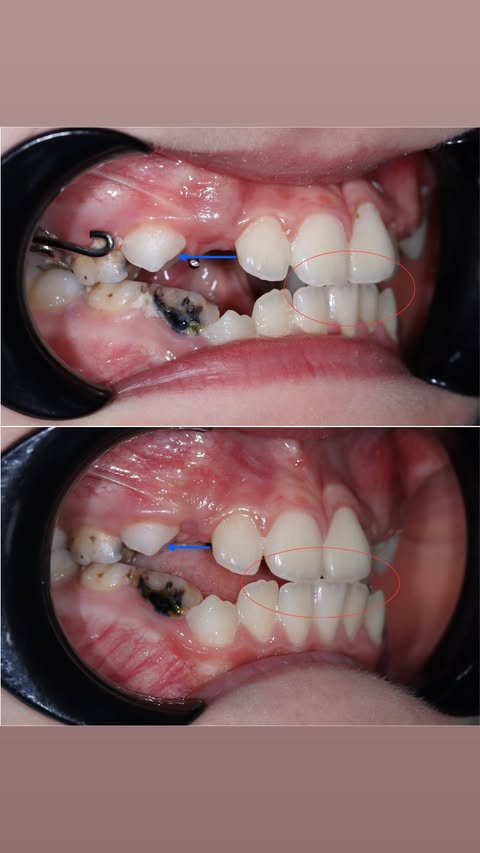 Реставрация зубов — восстановление повреждённых зубов у детей