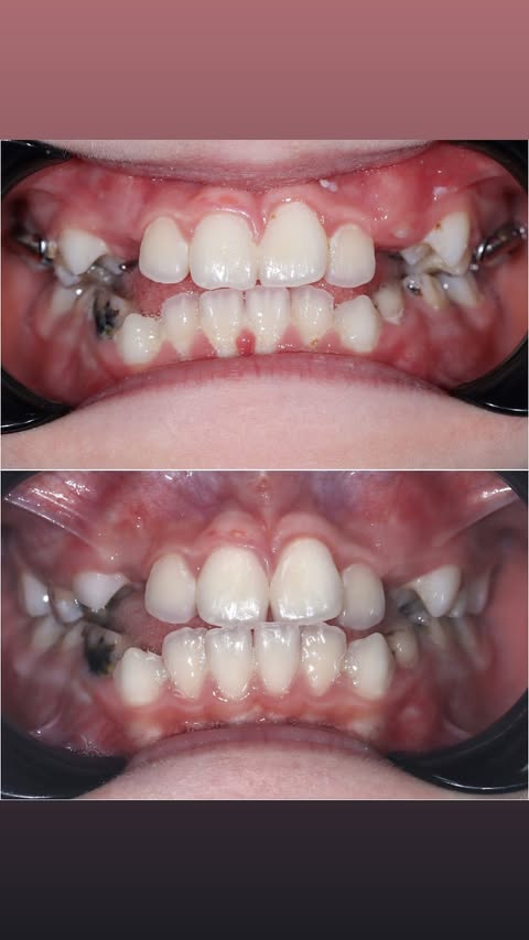После лечения — ровные зубы