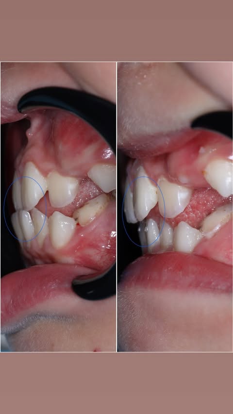 До ортодонтии — боковой вид