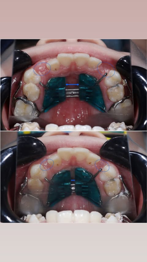 После ортодонтии — боковой вид