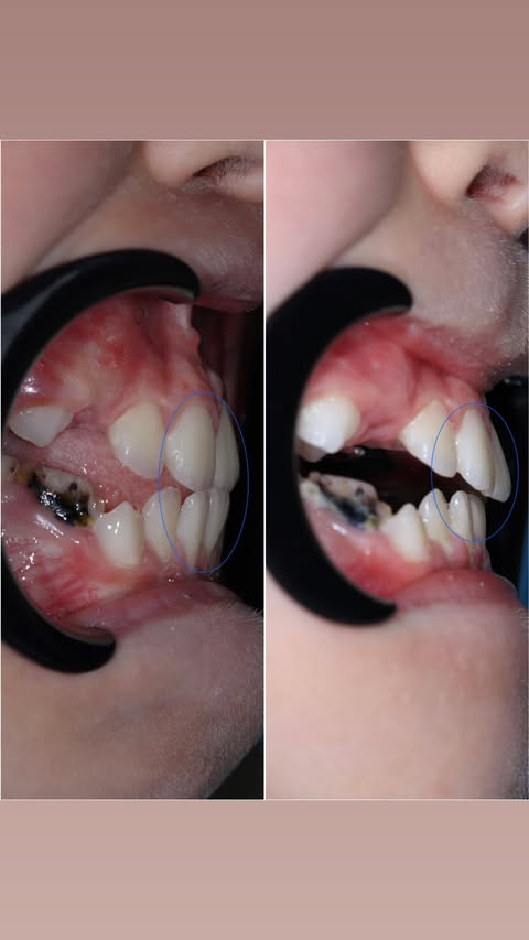 До лечения — неровный зубной ряд