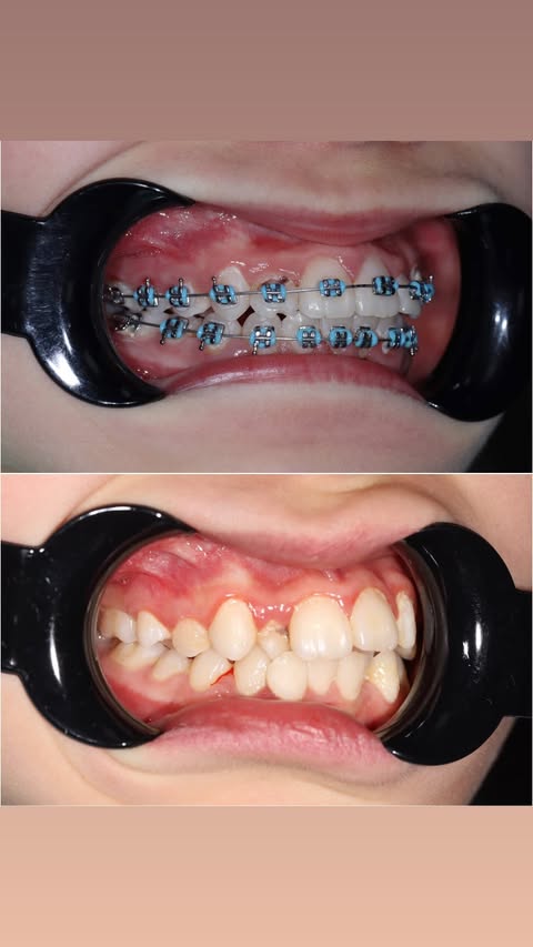 После лечения — ровные зубы